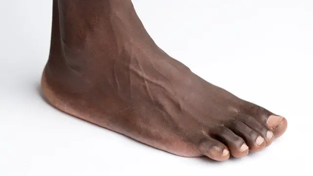 Side view of a bare foot on a white background with raised veins visible across the top of the foot and ankle