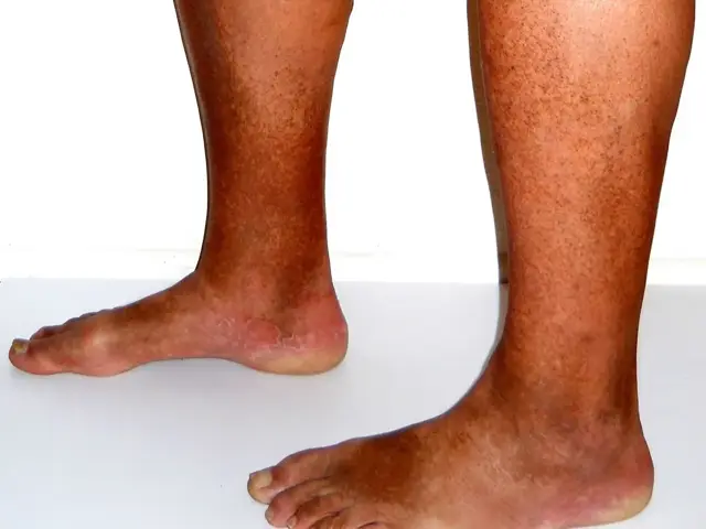 Lower legs and feet showing brownish skin discolouration around the ankles, photographed against a white background