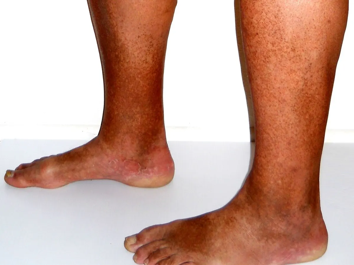 Lower legs and feet showing brownish skin discolouration around the ankles, photographed against a white background