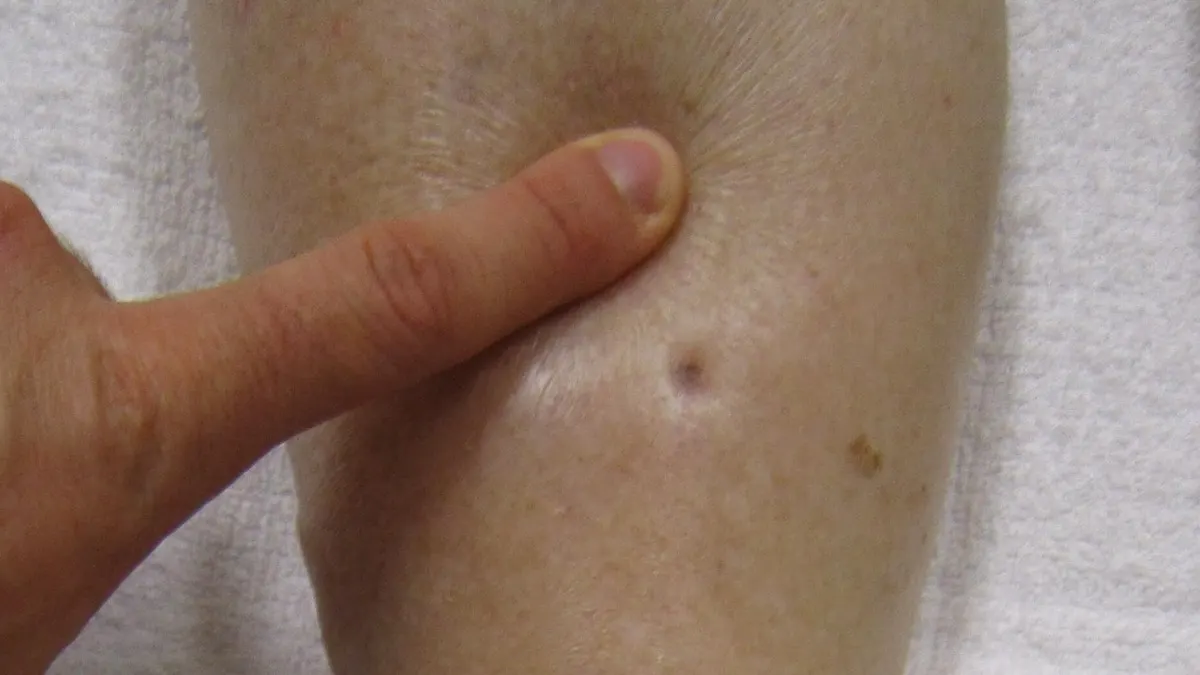 A finger pressing into a swollen lower leg, leaving a visible dent in the skin