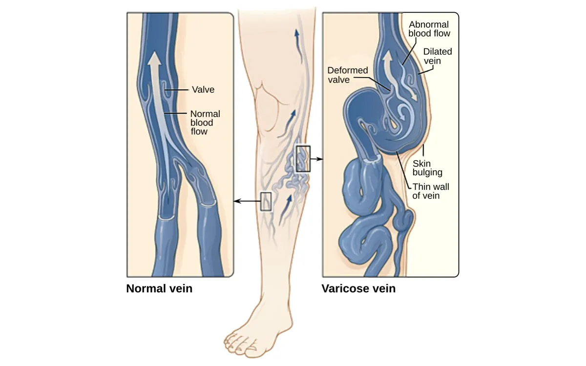 Anatomical illustration of a leg comparing a normal vein with a valve to an enlarged, twisted varicose vein