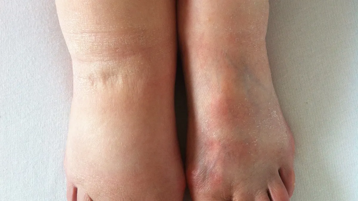Two bare ankles and feet side by side on a plain sheet, the left one visibly wider and puffier than the right