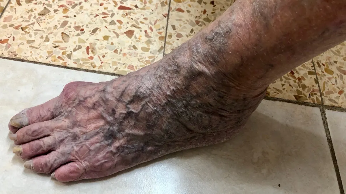 Dark, twisting veins and skin discolouration visible across the top of a bare foot and ankle resting on a tiled floor