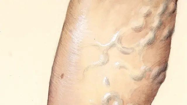 Watercolour painting of a lower leg showing twisted, raised varicose veins with skin discolouration, on a plain cream background