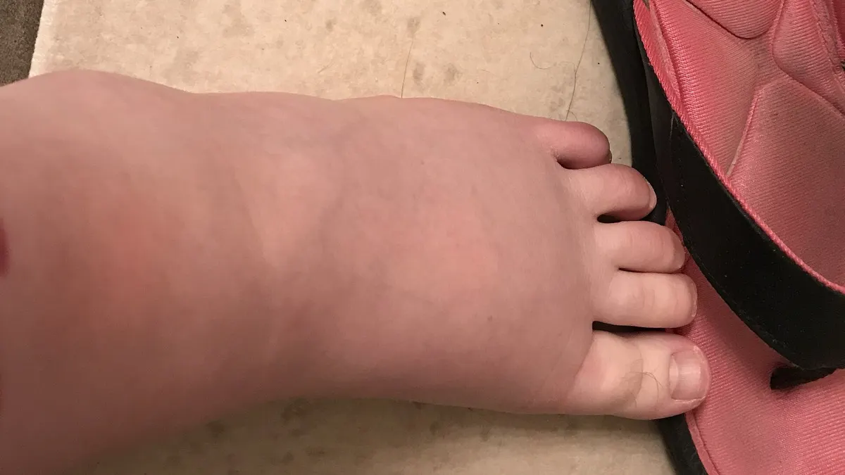 Close-up of a puffy, swollen foot and ankle resting on a tiled floor beside a pink flip-flop